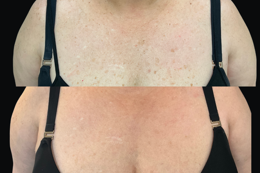 aai-bbl-halo-on-chest