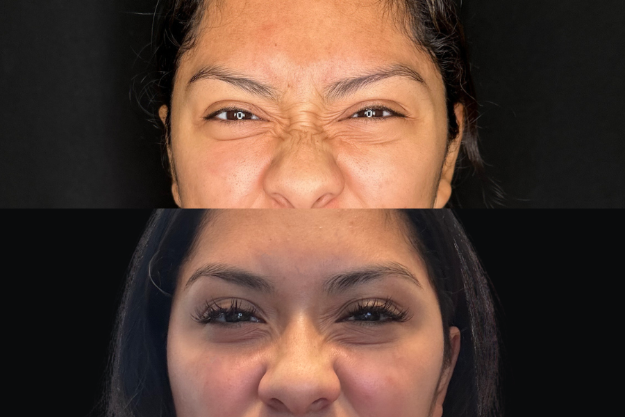 aai-botox-on-bunny-lines