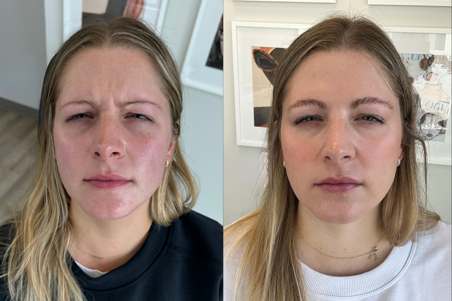 aai-botox-on-glabella2