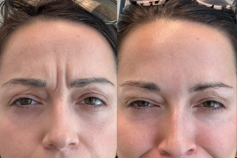 aai-botox-on-glabella3