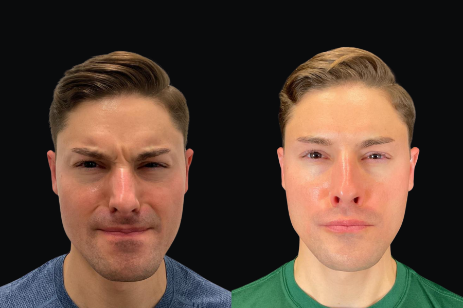 aai-botox-on-glabella4