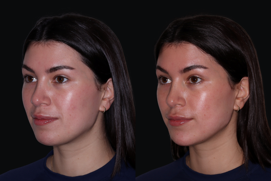 aai-chin-jawline-filler