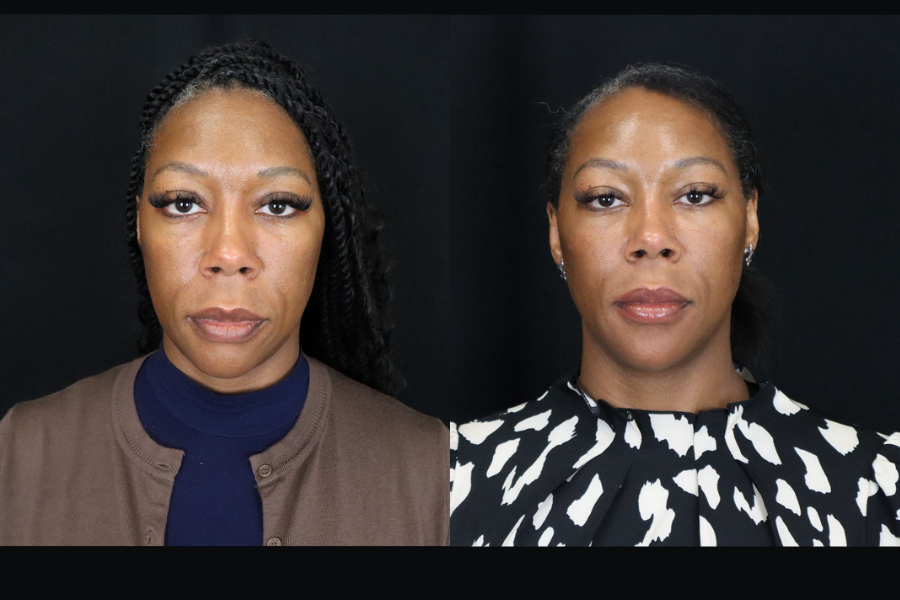 aai-full-facial-balancing-2