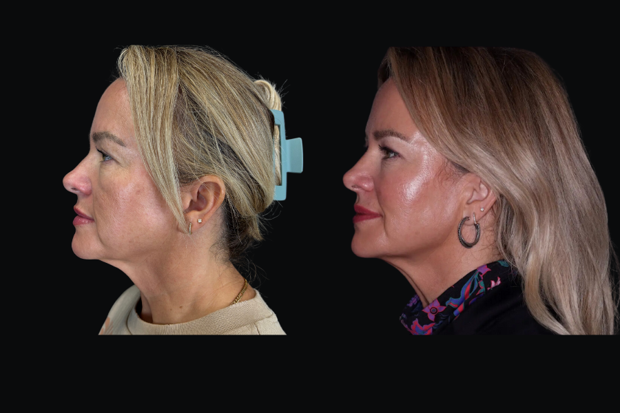 aai-full-facial-balancing-5