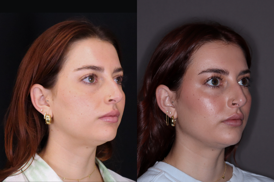 aai-full-facial-balancing-7