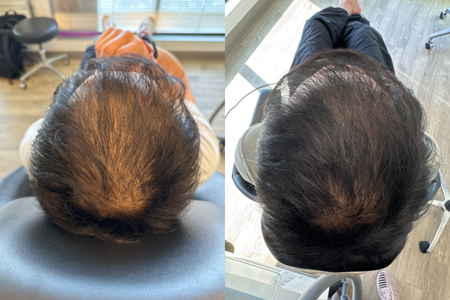 aai-prf-hair-restoration