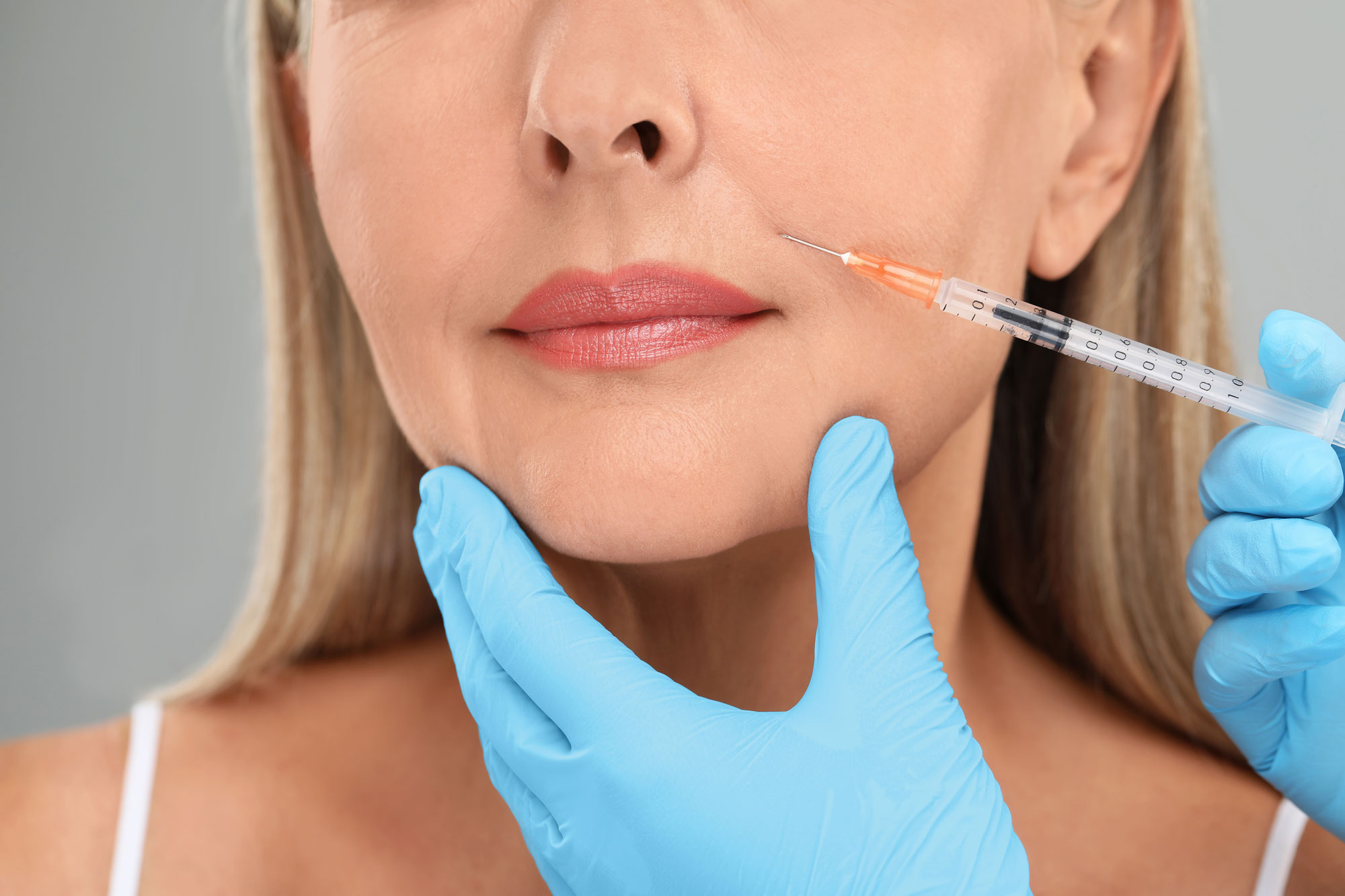 Close-up of dermal fillers for smile lines being injected to smooth nasolabial folds and restore facial volume.