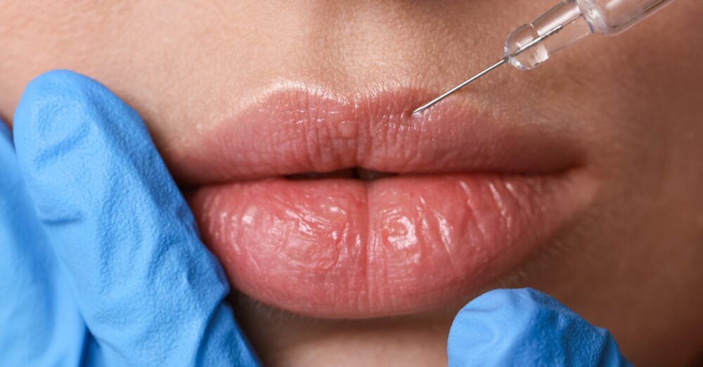 Provider in blue gloves administering a lip filler injection to a female